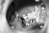 Oral thrush.