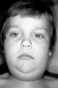 Child with mumps.